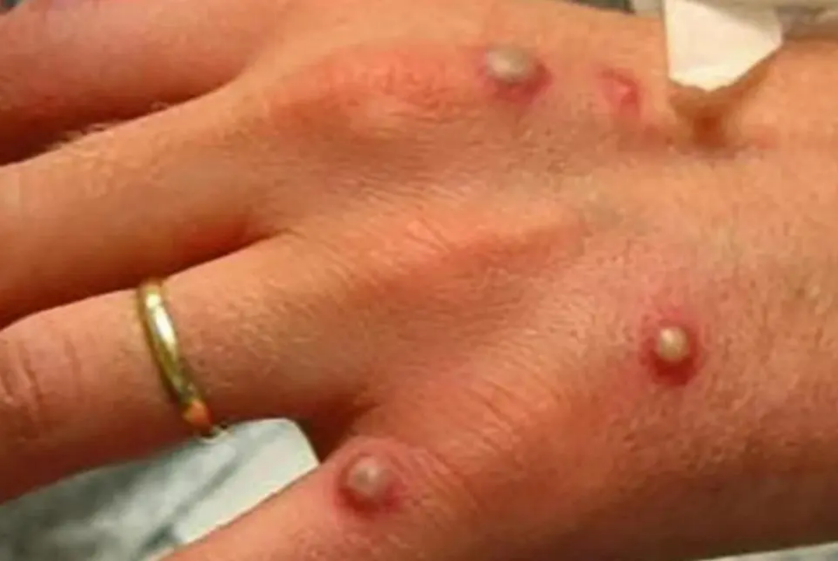 monkeypox symptoms